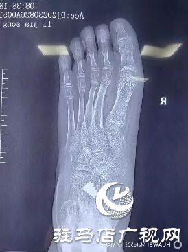 九游体育网站：驻马店市第一人民医院：距下关节制动术让脚不再“躺平”(图1)