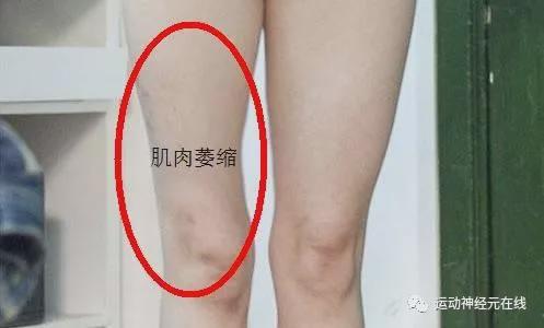 运动神经元病无力肌肉跳动一个方剂轻松改善！(图1)